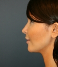 Feel Beautiful - Implant at Base of Nose - After Photo