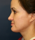 Feel Beautiful - Implant at Base of Nose and Top of Nose - Before Photo