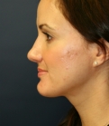 Feel Beautiful - Implant at Base of Nose and Top of Nose - After Photo