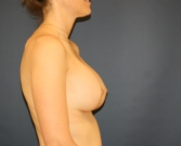 Feel Beautiful - Breast Implants San Diego 123 - After Photo
