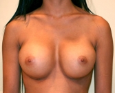 Feel Beautiful - Breast Augmentation Case 10 - After Photo