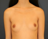 Feel Beautiful - Natural Breast Augmentation 6 - Before Photo