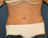 Feel Beautiful - Tummy-Tuck-San-Diego-Revision-90 - Before Photo