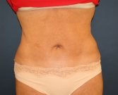 Feel Beautiful - Tummy-Tuck-San-Diego-Revision-90 - After Photo