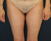 Feel Beautiful - Liposuction Upper Inner Thighs - Before Photo