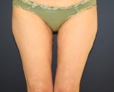 Feel Beautiful - Liposuction Upper Inner Thighs - After Photo