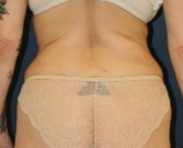 Feel Beautiful - Liposuction Flanks, Waist, Sides - Before Photo