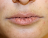 Feel Beautiful - Lip Augmentation with Restylane Defyne - Before Photo
