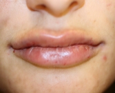 Feel Beautiful - Lip Augmentation with Restylane Defyne - After Photo