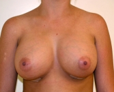 Feel Beautiful - Breast Augmentation Case 11 - After Photo