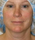 Feel Beautiful - Necklift Case 2 - Before Photo