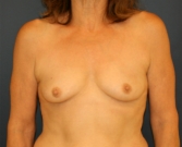 Feel Beautiful - Proportionate Breast Augmentation - Before Photo