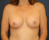 Feel Beautiful - Proportionate Breast Augmentation - After Photo