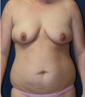 Feel Beautiful - Breasts and Tummy - Before Photo