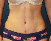 Feel Beautiful - Tummy Tuck After Lipo San Diego - After Photo