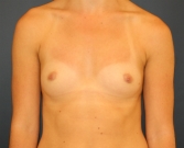 Feel Beautiful - Breast Augmentation  San Diego - Before Photo