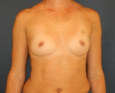 Feel Beautiful - Breast Augmentation San Diego 550 cc - Before Photo
