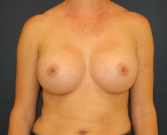 Feel Beautiful - Breast Augmentation San Diego 550 cc - After Photo