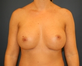 Feel Beautiful - Breast Augmentation San Diego 400 cc - After Photo