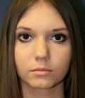 Feel Beautiful - Rhinoplasty (for smaller nose) - Before Photo