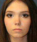 Feel Beautiful - Rhinoplasty (for smaller nose) - After Photo