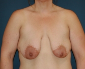 Feel Beautiful - Breasts Uplifted San Diego - Before Photo