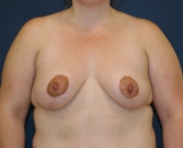 Feel Beautiful - Breasts Uplifted San Diego - After Photo