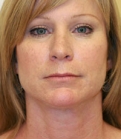 Feel Beautiful - Necklift Case 2 - After Photo