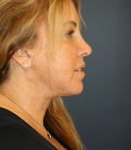 Feel Beautiful - Neck Lift - After Photo