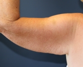 Feel Beautiful - Left Arm Lift San Diego after weight loss - Before Photo