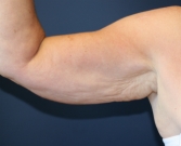 Feel Beautiful - Right Arm Lift After Weight Loss San Diego - Before Photo