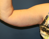 Feel Beautiful - Right Arm Lift After Weight Loss San Diego - After Photo