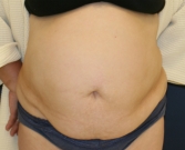 Feel Beautiful - Tummy-Tuck-for-hanging-skin - Before Photo