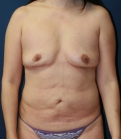 Feel Beautiful - Mommy-Makeover-Revision - Before Photo