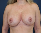 Feel Beautiful - Breast Lift San Diego (implants not changed) - After Photo