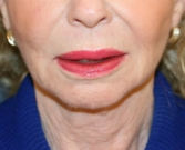 Feel Beautiful - Jowl Removal (non-surgical facelift) - Before Photo