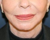 Feel Beautiful - Jowl Removal (non-surgical facelift) - After Photo