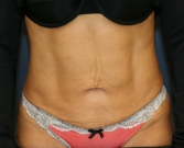 Feel Beautiful - Tummy Tuck Loose Skin Only - Before Photo