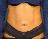 Feel Beautiful - Tummy Tuck Loose Skin Only - After Photo