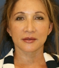 Feel Beautiful - Lower Face and Neck Lift San Diego - After Photo