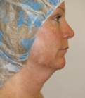 Feel Beautiful - Necklift Case 2 - Before Photo