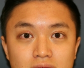Feel Beautiful - Double Eyelid (Asian) - After Photo