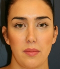 Feel Beautiful - Revision Rhinoplasty - After Photo