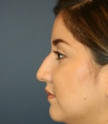 Feel Beautiful - female nose surgery san diego - Before Photo