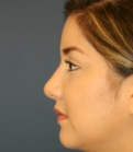 Feel Beautiful - female nose surgery san diego - After Photo
