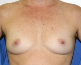 Feel Beautiful - Breast Augmentation Case 15 - Before Photo