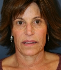 Feel Beautiful - Facelift, Necklift, Laser Skin Rx - Before Photo