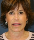 Feel Beautiful - Facelift, Necklift, Laser Skin Rx - After Photo