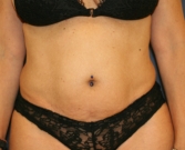 Feel Beautiful - Tummy-Tuck-and-Liposuction-Waist - Before Photo