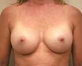 Feel Beautiful - Breast Augmentation Case 15 - After Photo